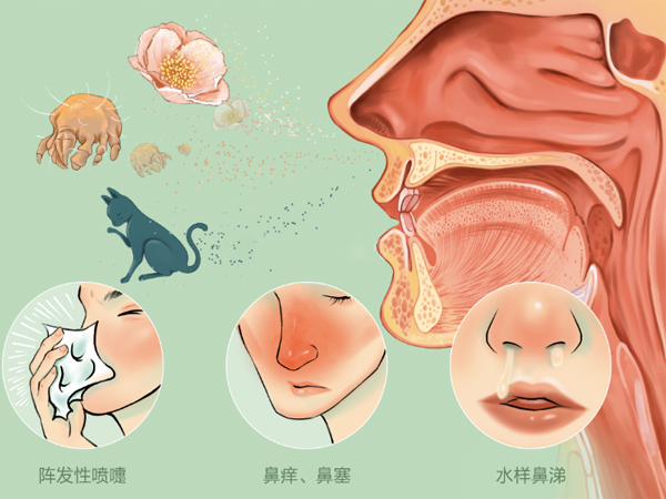 有鼻炎能做试管婴儿吗